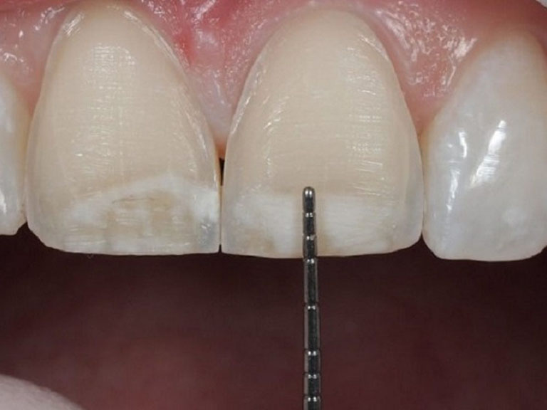 Dán sứ veneer có đau không? Giải đáp từ chuyên gia nha khoa