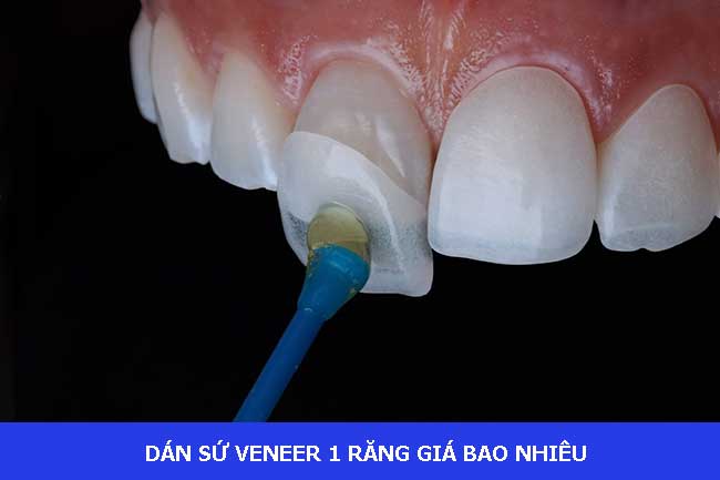 Dán Răng Sứ Veneer Giá Bao Nhiêu? Bảng Giá Mới Nhất 2025 & Tư Vấn Chi Tiết