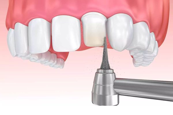 Dán sứ có cần mài răng không