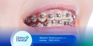 Niềng răng khớp cắn ngược