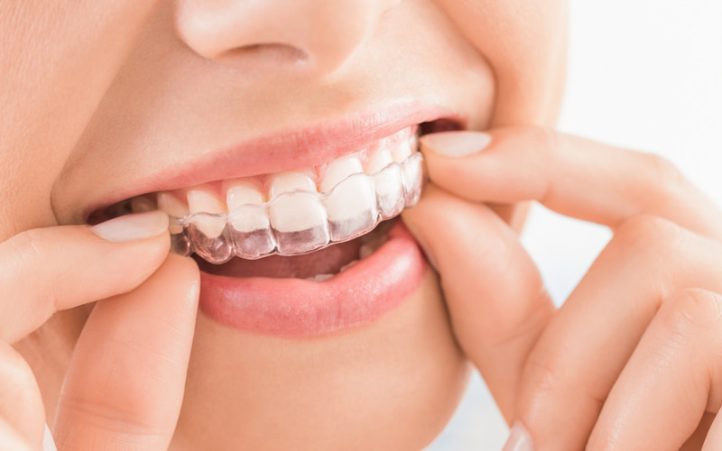 Hạn chế niềng răng trong suốt
