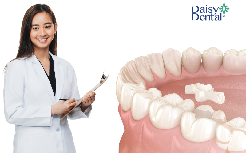 Bạn cần gỡ miếng trám răng vì nhiều lý do khác nhau, chủ yếu là để đảm bảo sức khỏe răng miệng lâu dài và tránh các vấn đề nghiêm trọng hơn.