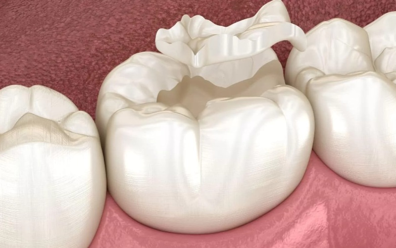 Việc gỡ miếng trám răng có thể không đau hoặc chỉ đau nhẹ, tùy thuộc vào một vài yếu tố.