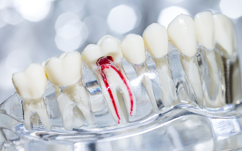 Bất kỳ tình huống nào dẫn đến viêm nhiễm, tổn thương hoặc chết tủy răng đều có thể là chỉ định cần thiết để tiến hành điều trị tủy răng.