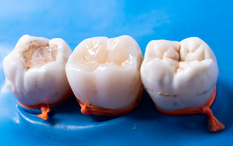 Nếu miếng trám răng của bạn bị đen, bạn nên đến gặp nha sĩ để được thăm khám và xác định chính xác nguyên nhân.