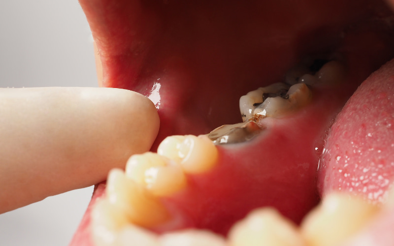 Sâu răng thứ phát và vi khuẩn tích tụ xung quanh miếng trám có thể gây ra mùi hôi khó chịu trong khoang miệng.