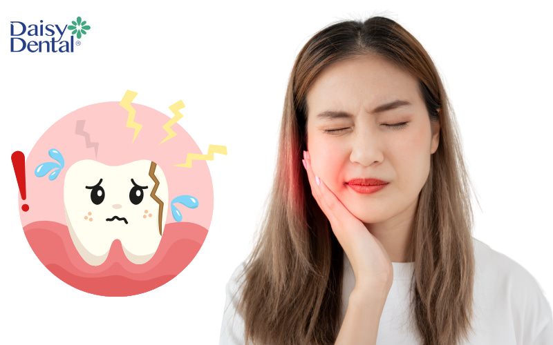 Răng bị nứt là tình trạng khá phổ biến, có thể gây ra nhiều khó chịu và ảnh hưởng đến sức khỏe răng miệng.