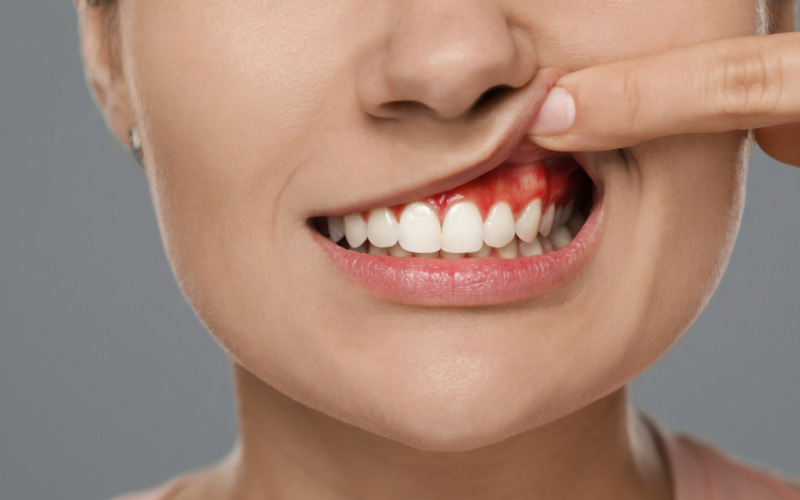 Nướu xung quanh răng trám có thể bị sưng đỏ, đau hoặc chảy máu.