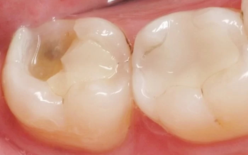 Miếng trám răng có thể bị hỏng hoặc bung ra do nhiều nguyên nhân khác nhau