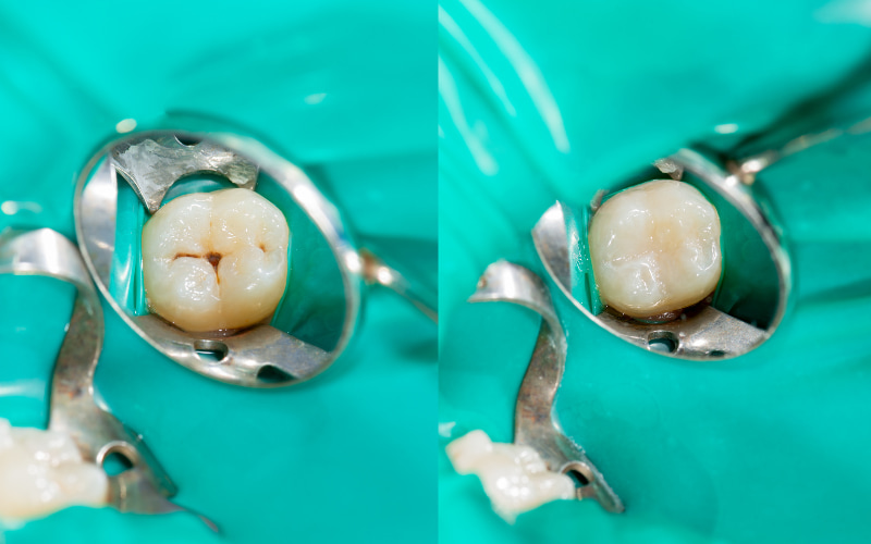 Nếu bạn đang gặp phải tình trạng trám răng bị cộm, bạn nên sớm đến gặp nha sĩ để được kiểm tra và điều chỉnh lại miếng trám cho phù hợp