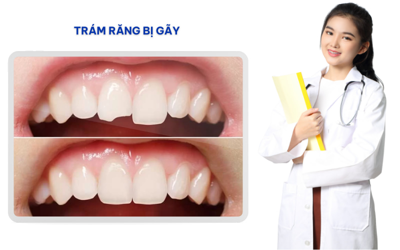 Để biết chính xác phương pháp điều trị phù hợp nhất, bạn nên đến nha sĩ để được thăm khám và tư vấn cụ thể nhé.