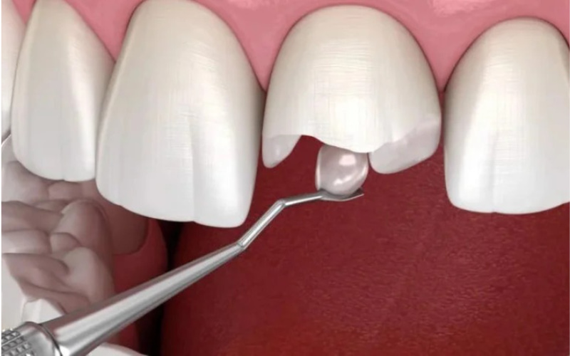 Việc trám răng bị gãy có đau không phụ thuộc vào nhiều yếu tố như mức độ gãy, tình trạng tủy răng và cơ địa của mỗi người.
