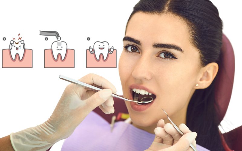 Trám răng không bền vĩnh viễn nhưng có độ bền khá tốt, dao động từ vài năm đến hơn chục năm, tùy thuộc vào nhiều yếu tố.
