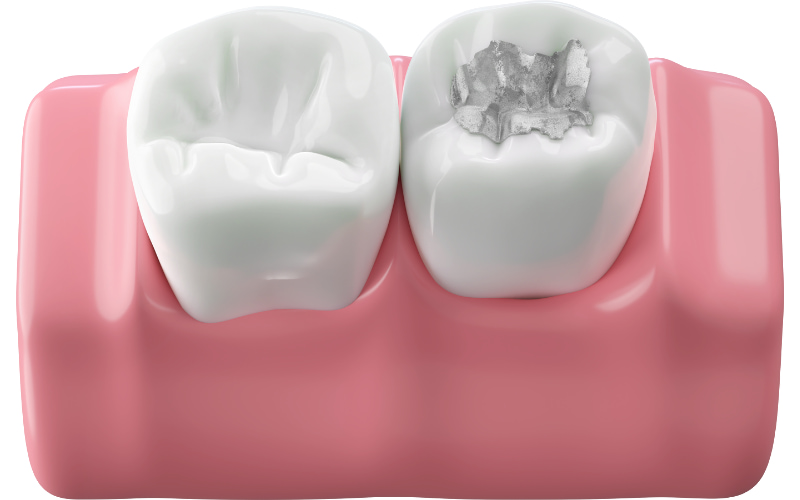 Trám răng kịp thời sẽ giúp bảo tồn răng thật tối đa, tránh các biến chứng nghiêm trọng và tiết kiệm chi phí điều trị.
