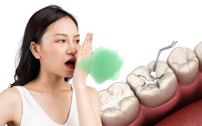 Thông thường, bản thân việc trám răng không trực tiếp gây hôi miệng