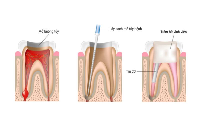 Các ống tủy sẽ được trám bít kín bằng vật liệu nha khoa chuyên dụng.