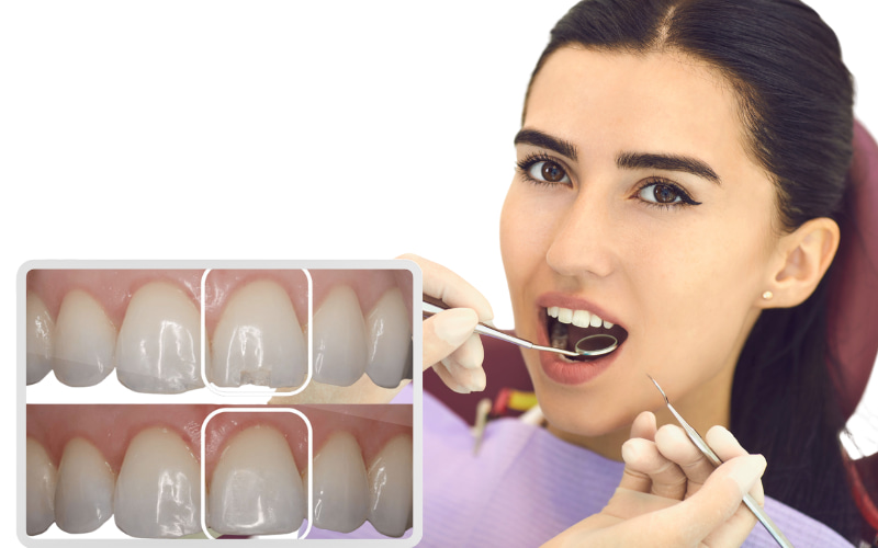 Răng bị mẻ là tình trạng một phần nhỏ hoặc lớn của răng bị vỡ ra, thường đi kèm với cảm giác ê buốt hoặc đau nhức.