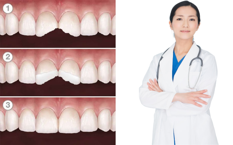 Phần lớn các trường hợp trám răng cửa bị mẻ chỉ tác động đến lớp men răng bên ngoài, không ảnh hưởng đến tủy răng nên quá trình trám diễn ra khá nhẹ nhàng.