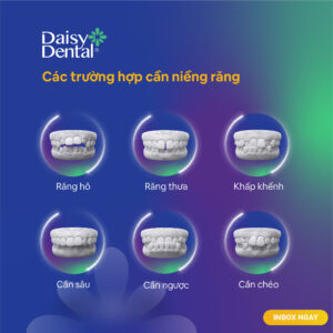 Niềng răng trả góp 0%, Ưu đãi niềng răng tháng 7