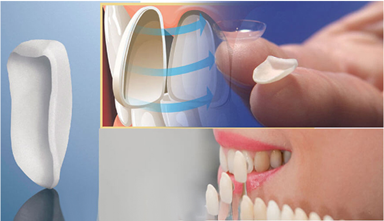 Dán sứ veneer có đau không