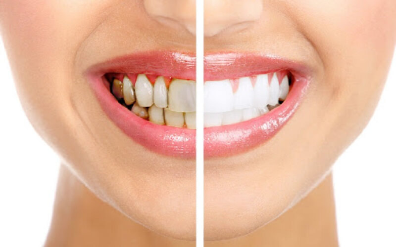 Tẩy trắng răng – Khắc phục răng xỉn màu, ố vàng