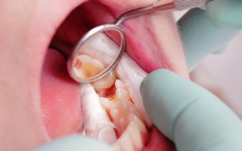 Điều trị tủy khi đau nhức răng lúc ăn nhai