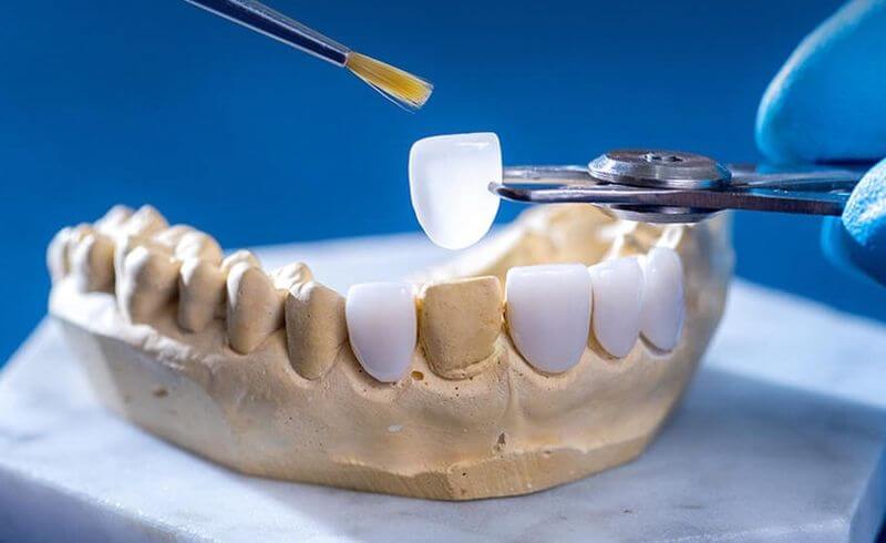 Bác sĩ lấy mẫu răng gửi về phòng Labo để chế tác