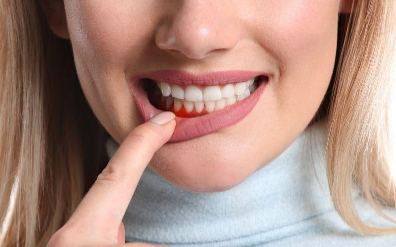 Bệnh nha chu là một trong những nguyên nhân gây nên áp xe răng