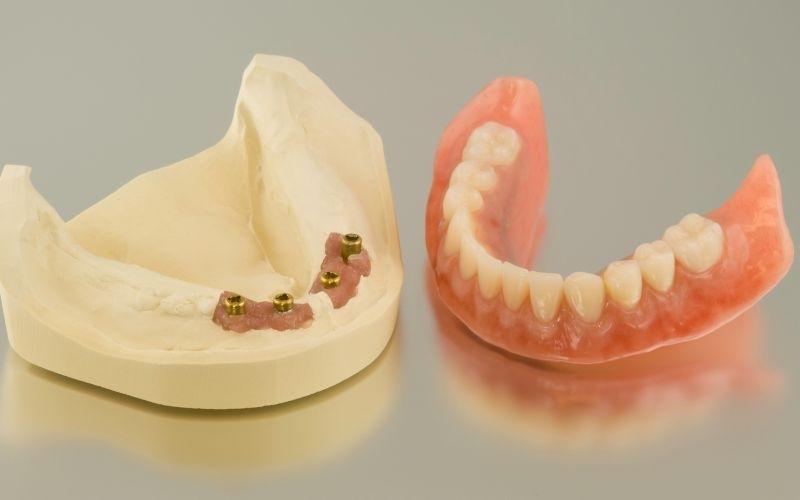 Cấy ghép Implant là phương pháp khôi phục răng đã mất tốt nhất hiện nay