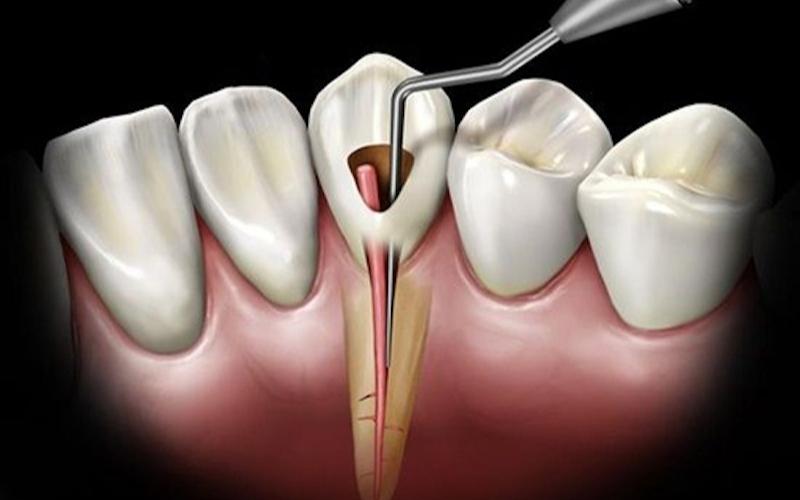 Mỗi vị trí răng sẽ có thời gian điều trị tủy khác nhau