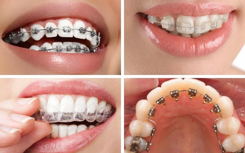 Các phương pháp niềng răng tại nha khoa Bình Dương