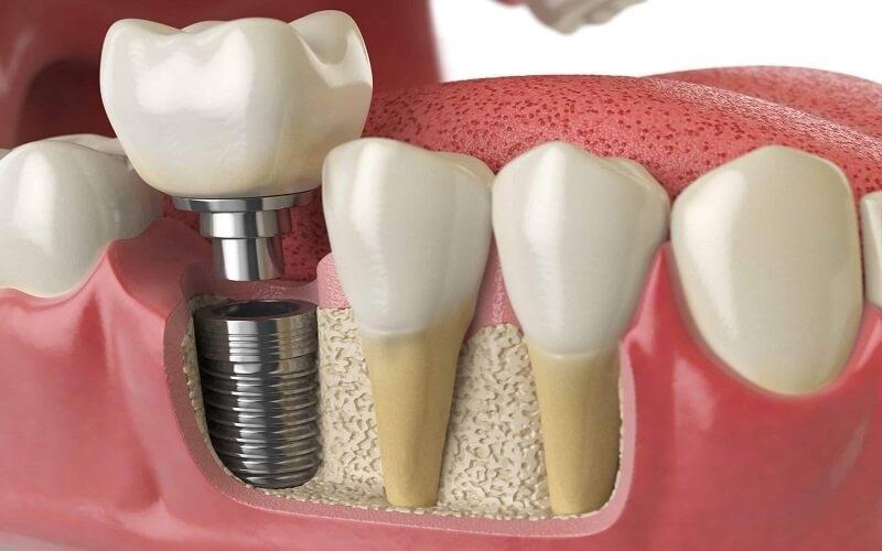 Chụp CT hỗ trợ trồng răng Implant