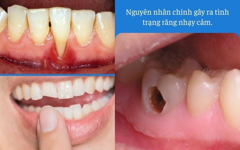 Các bệnh lý răng miệng có thể khiến răng bị nhạy cảm
