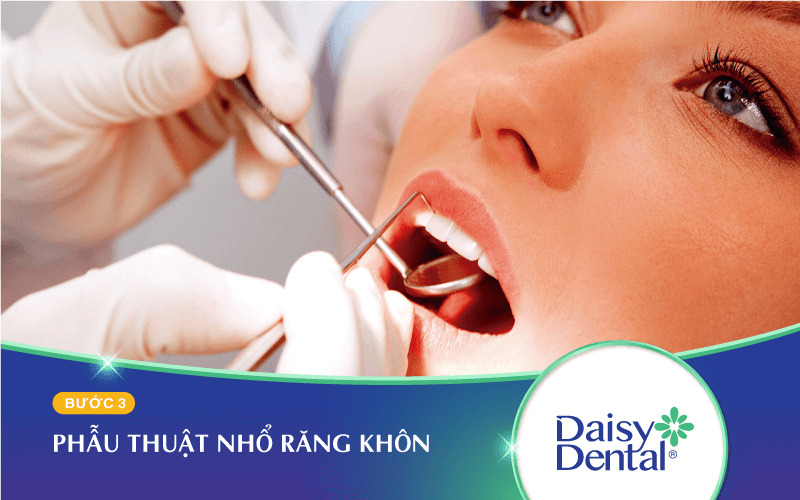 Tùy theo từng tình trạng răng mà phẫu thuật răng khôn có thể kéo dài từ 15 - 30 phút