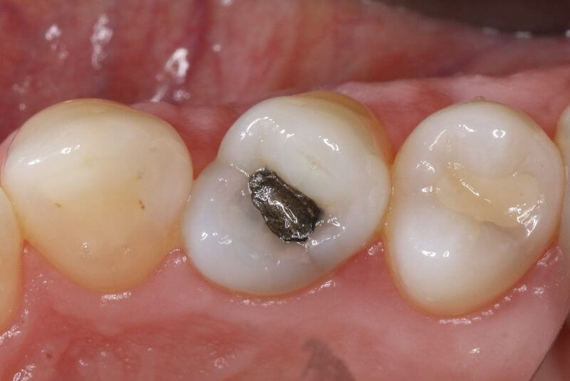 Trám răng bằng chất liệu hỗn hợp bạc