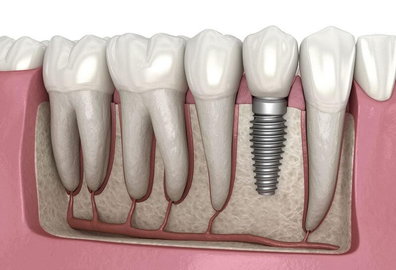 Trồng răng Implant hạn chế tình trạng tiêu xương khi mất răng lâu ngày