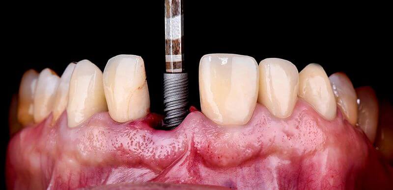 Địa chỉ cấy ghép răng Implant ở Biên Hòa Đồng Nai chất lượng