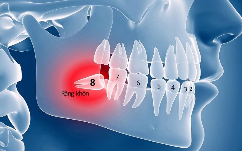 Nhổ răng khôn giúp xóa bỏ cơn đau nhức