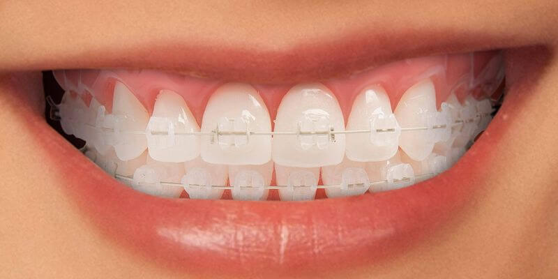 Niềng răng bằng mắc cài sứ có thể phù hợp với màu của tất cả các răng