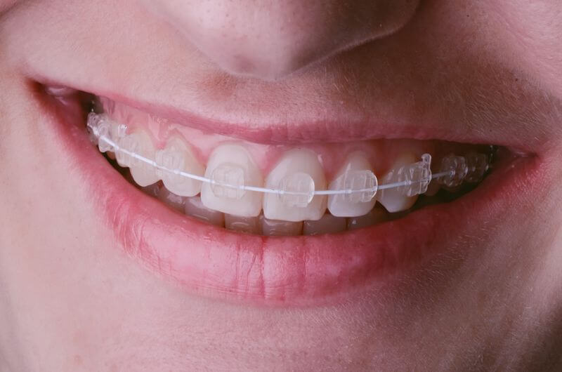 Phương pháp niềng răng giúp người dùng cải thiện thẩm mỹ khuôn mặt và tự tin hơn trong giao tiếp