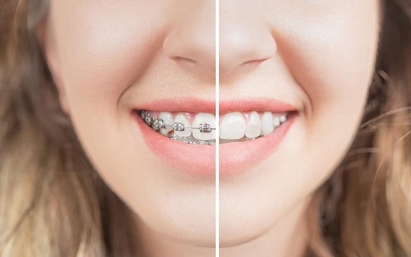 Niềng răng là phương pháp di chuyển về vị trí chuẩn trên cung hàm