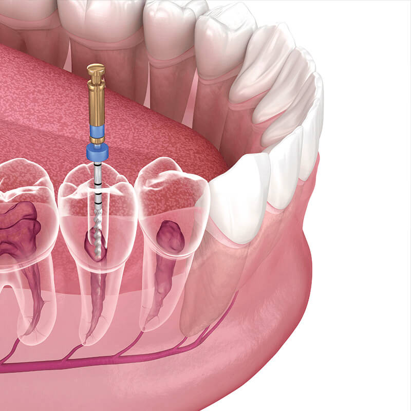 Trường hợp tủy yếu cần dùng que kim lành tính đặt vào ống tủy để nâng đỡ cấu trúc răng