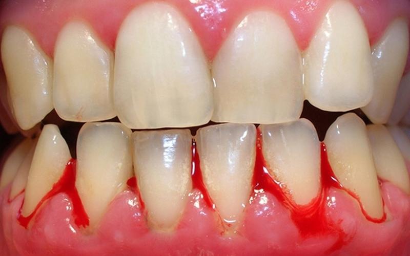 Bệnh nhân bị viêm lợi răng cấp tính không được nhổ răng