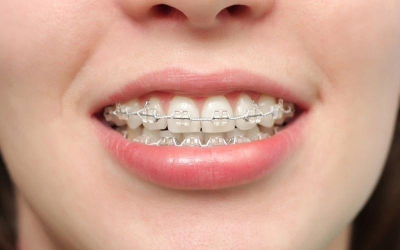 Nhổ răng được chỉ định trong một số trường hợp niềng răng