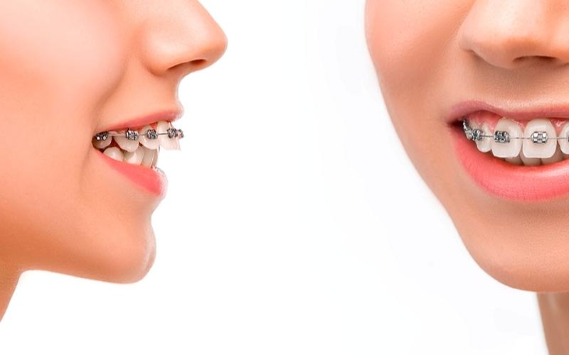 Niềng răng vẩu sẽ mất thời gian từ 1,5 - 2 năm