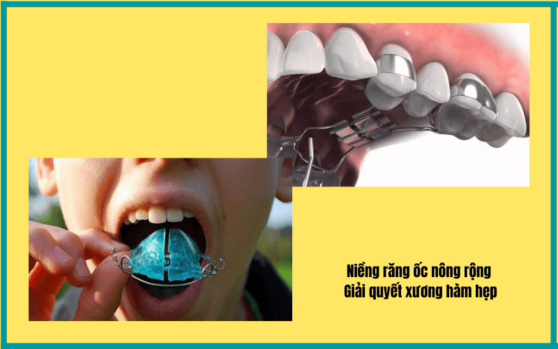 Niềng răng ốc nông rộng giúp giải quyết tình trạng xương hàm hẹp