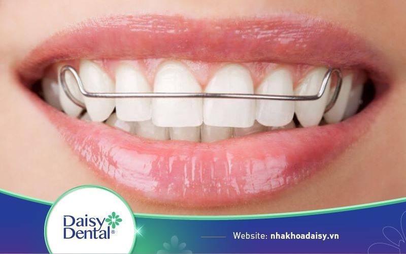Những điều cần biết và lưu ý khi niềng răng để có hàm răng đẹp