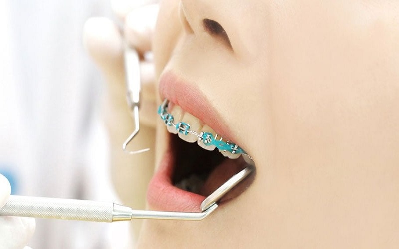 Niềng răng là kỹ thuật chỉnh nha nắn chỉnh răng hàm lệch lạc được nhiều người sử dụng
