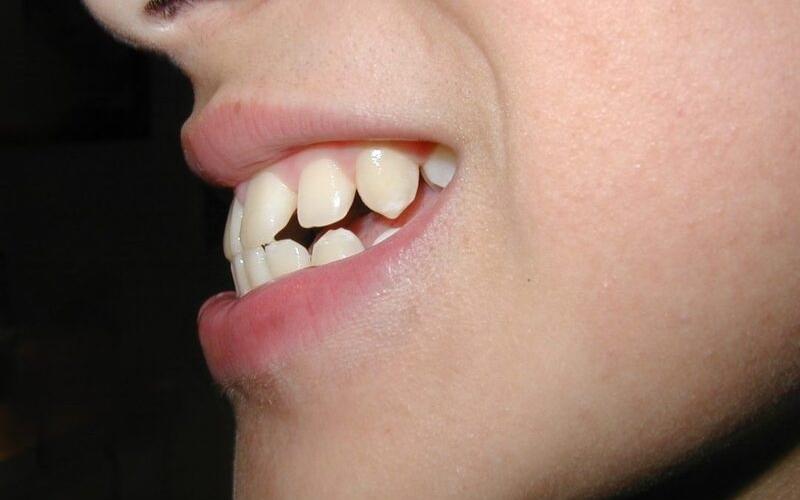 Tật đẩy lưỡi là nguyên nhân làm răng không đều