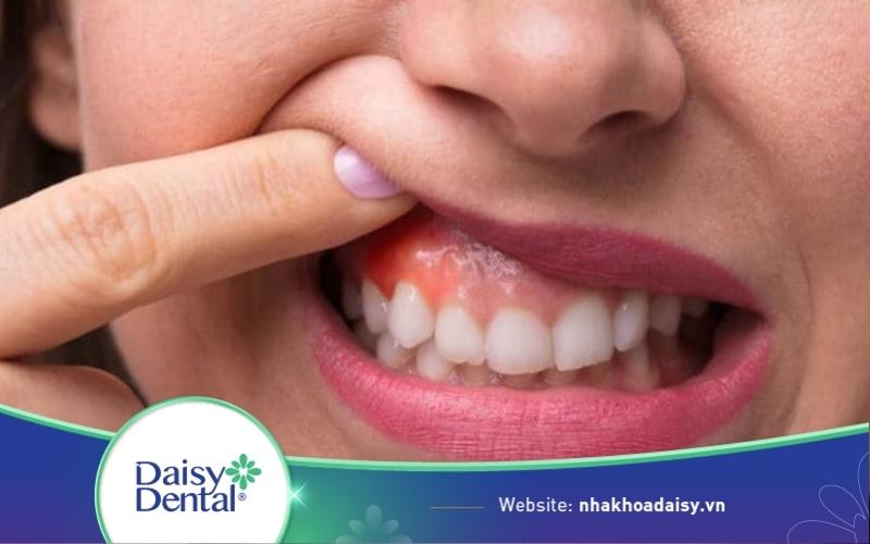 Tại sao niềng răng bị hở lợi? Cách khắc phục hiệu quả nhất